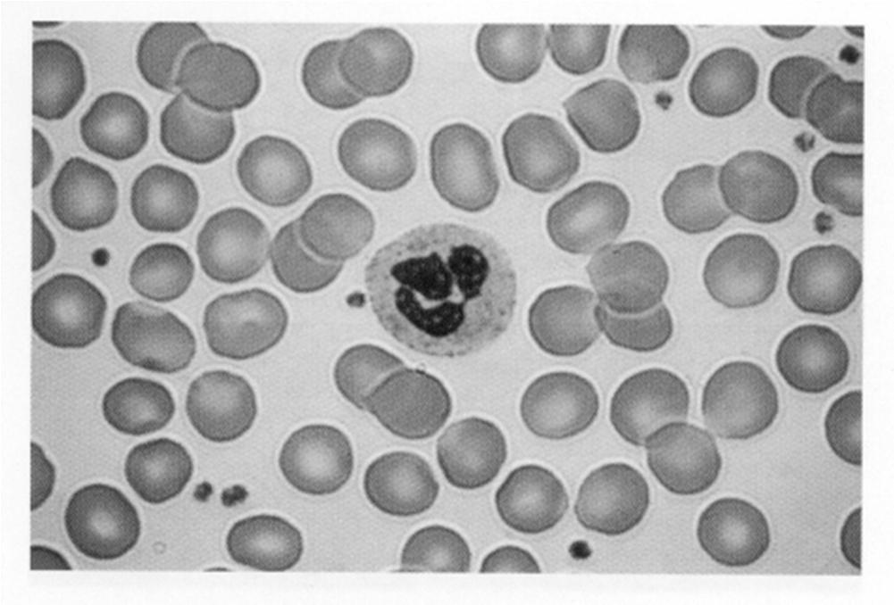 Normal RBCs, a single granulocyte