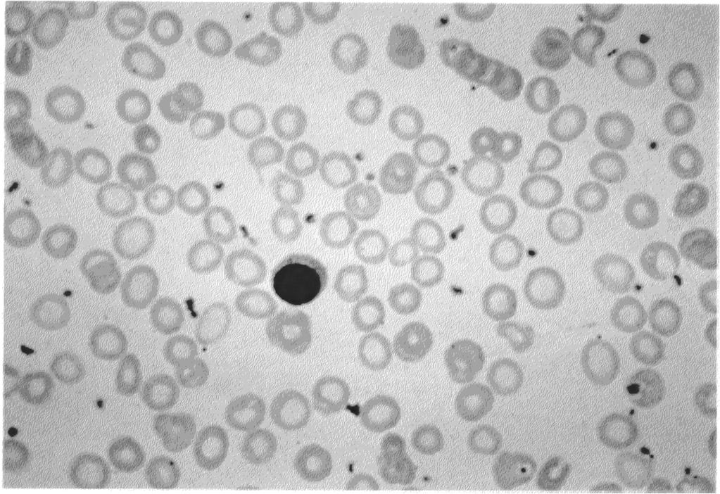 micocytic and hypochromic (central