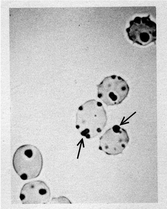 Heinz bodies Microscopically visible refractile intraerythrocyte hemoglobin precipitates (oxidized and denatured) that attach to the internal surface of the red cell membrane.