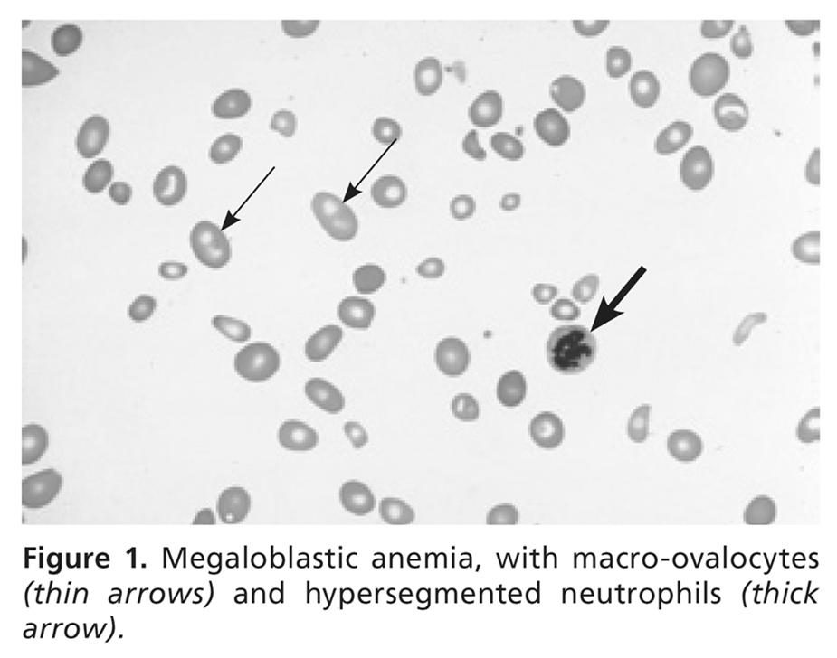 Megaloblastic Anemia Result of a defect in DNA synthesis and repair due to a perturbation in thymidine synthesis.