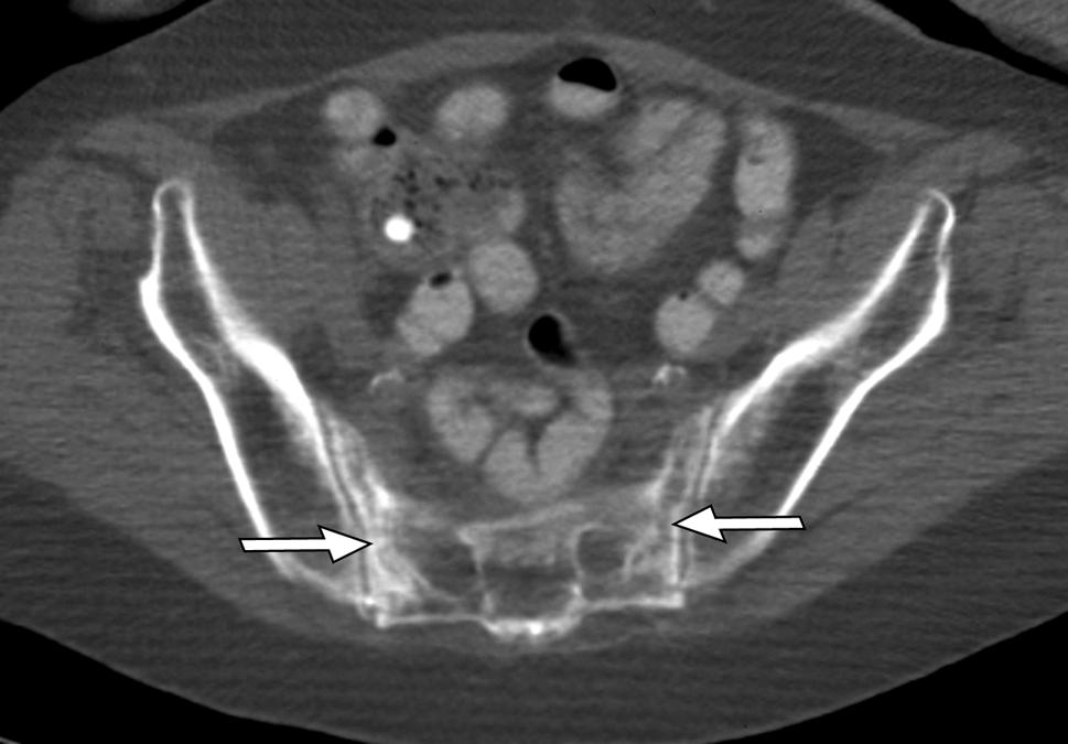 Sacral fractures are often unrecognized in patients, despite associated symptomatology, because of the subtlety of findings on conventional radiographs.