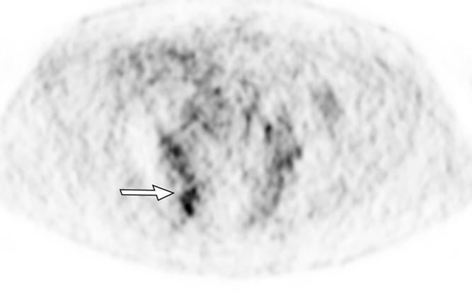 , xial PET scan again shows moderate diffuse FDG uptake predominantly in right sacrum (arrow).