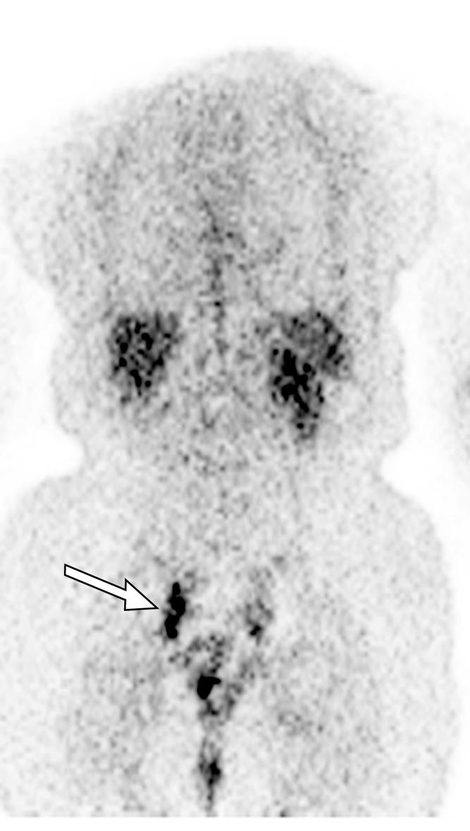 abnormalities representing sacral fractures (arrows).