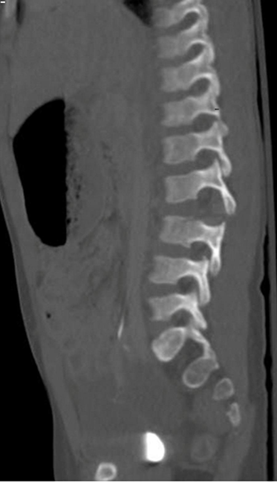 FIGURE 1: Sagittal CT scan with contrast of the lumbar spine 2017