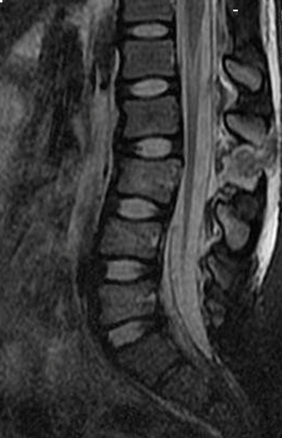 FIGURE 3: T2 weighted MRI of the lumbar spine without contrast revealing a hyperflexion injury with rupture of the interspinous ligaments and ligamentum flavum at