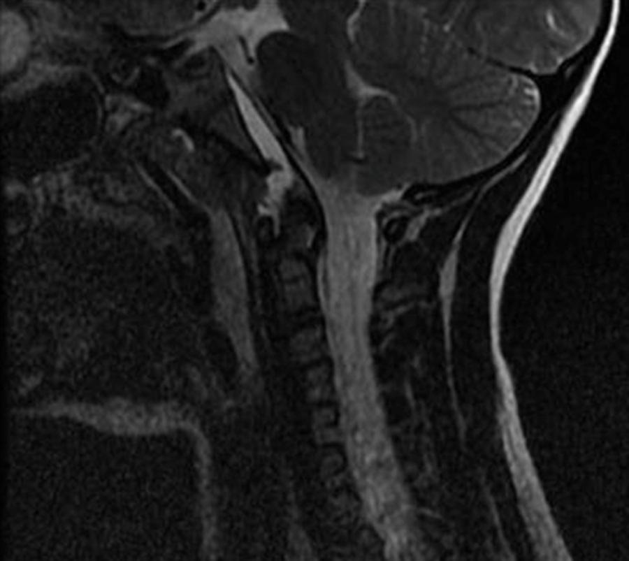 FIGURE 4: T2 weighted sagittal MRI of the cervical spine without contrast.