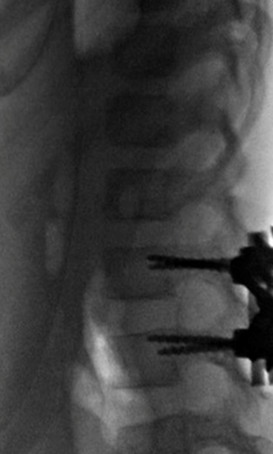 FIGURE 5: Intraoperative X-ray showing internal fixation and reduction of the facet