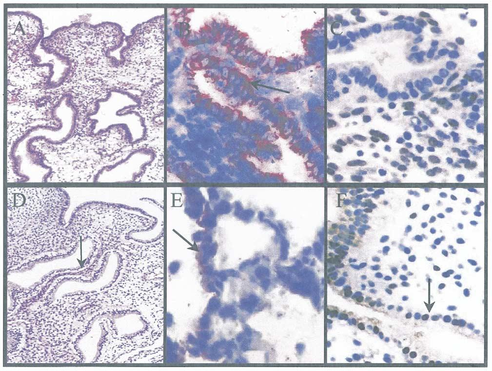 FIGURE 1 Hematoxylin-eosin (H & E) staining and immunohistochemical localization of 3 integrin and PR in endometrial biopsies obtained during the window of implantation from normal (A, B, C) and