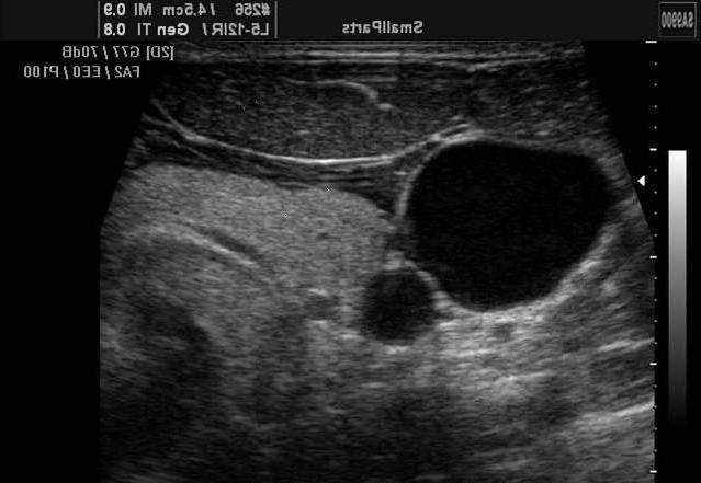 Preventing Mechanical Complications Use Ultrasound during insertion Associated with decreased risk for
