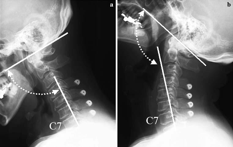 Eur Spine J (2008) 17:415 420 417 Fig. 1 Measurements of O C7 angle at flexion (a) or extension (b).