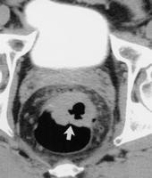 Focal asymmetrically thickened ulcerated mass (arrow) on