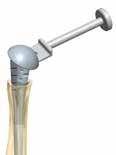 Removing the Humeral Head The Humeral Head can be removed using the Head Extractor.