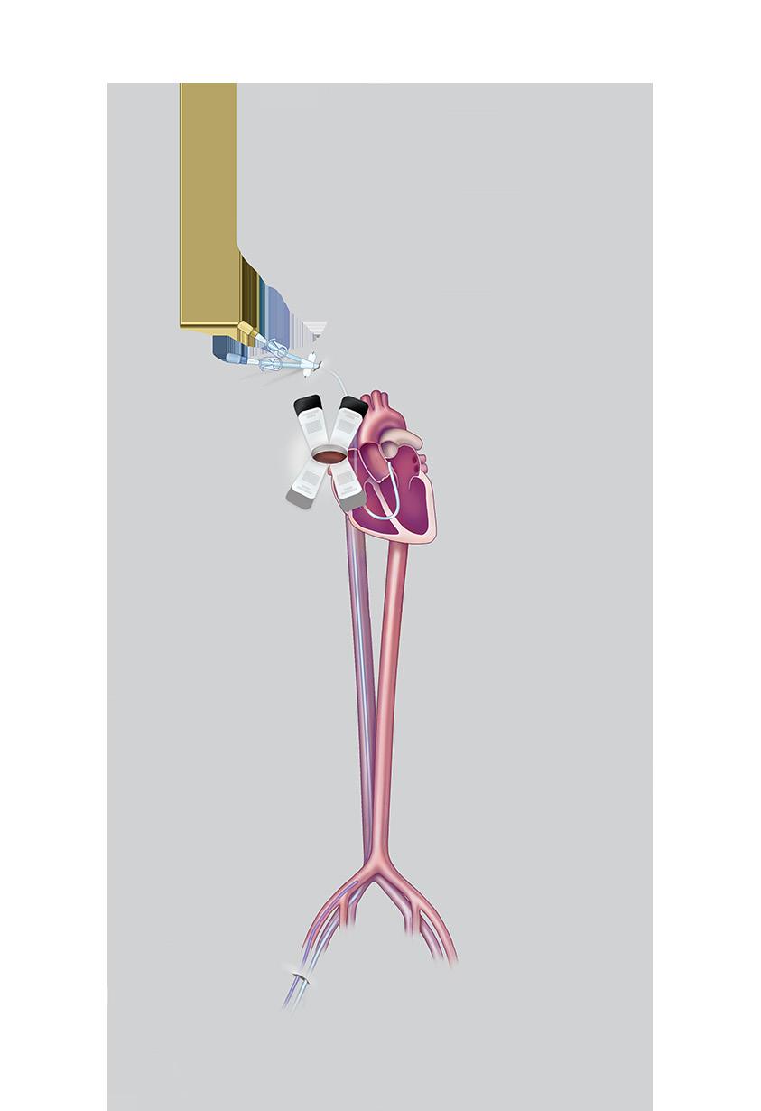 The TAVR procedure can be performed through multiple approaches, however the most common approach is the transfemoral approach (through an incision in the leg).