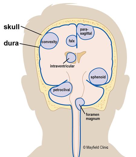 Meningioma tumor Overview A meningioma is a type of tumor that grows from the protective membranes, called meninges, which surround the brain and spinal cord.