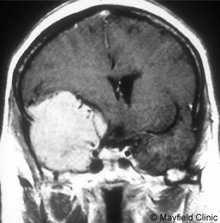 Convexity meningiomas: grow on the surface of the brain. They may not produce symptoms until they reach a large size. Symptoms include seizures, neurological deficits, or headaches.