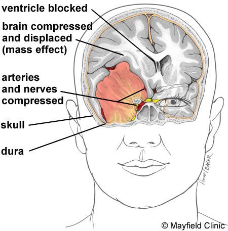 Because of the danger of injuring the sinuses, removing a tumor in this region can be difficult. Symptoms may include personality changes, headache, vision problems, and arm or leg weakness.