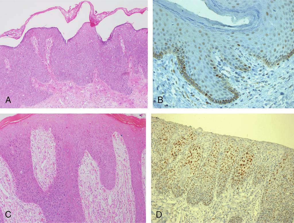 Journal of Lower Genital Tract Disease Volume 21, Number 1, January 2017 Carcinogenesis of Vulvar Lesions FIGURE 1. Usual VIN.