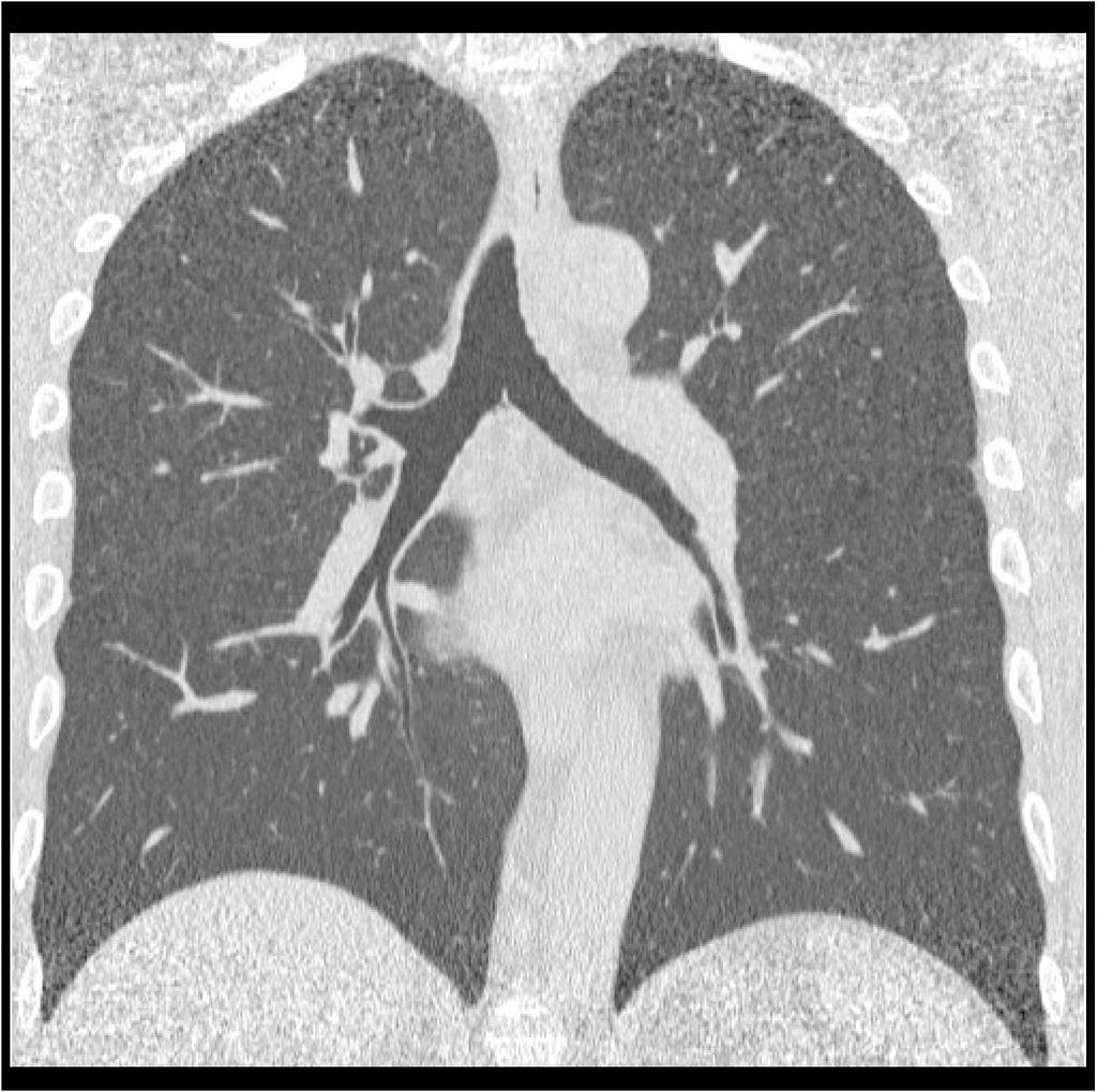 lung cancer screening in which CT scanning was performed at 50 mas. Figure B.
