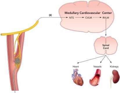 Figure 4. Carotid baroreceptor signaling. Diagram displaying carotid baroreceptor signaling to the medullary cardiovascular center within the brain and key efferent signaling targets in the periphery.