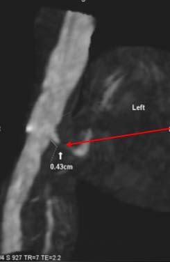 Left Renal Artery PACS, BIDMC.