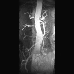 MRA of Another Patient Celiac Trunk Superior Mesenteric Artery Right Renal Artery Enlargement of Infrarenal