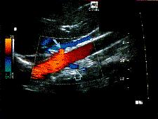 Doppler Ultrasound of Renal Arteries Right Renal Artery Abdominal Aorta