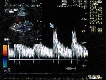 Doppler Ultrasound Waveforms Normal waveforms RAS waveforms Radiologic Clinics of North America 1996; 5: