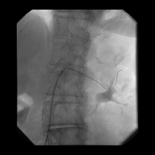 EO: Angioplasty This fluoroscopic image shows the positioning of a guidewire in a segmental renal artery Contrast in collecting system Black dots