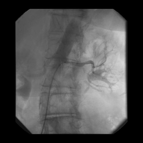 EO: Angioplasty Injection of contrast allows for visualization of angioplasty balloon in relation to stenotic lesion 3 and 5 mm