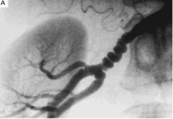 Patient 2: Characteristic Angiographic appearance of Fibromuscular Dysplasia Beaded, aneurysmal appearance of distal