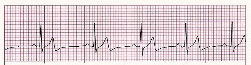 The cardiac monitor has been applied and reveals the following rhythm: 12. The rhythm displayed is: a. Bradycardia b. Ventricular fibrillation c. Sinus tachycardia d. Supraventricular tachycardia 13.