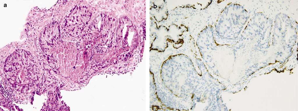 Materials and methods Twenty-seven cases of prostate biopsies with IDC-P were identified from the consult files of one of the authors between 2000 and 2005.