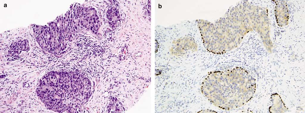 mitoses and pleomorphism. Of the 15 patients who did not receive radical prostatectomy, three patients developed bone metastases 6, 36, and 48 months after the diagnosis of IDC-P.