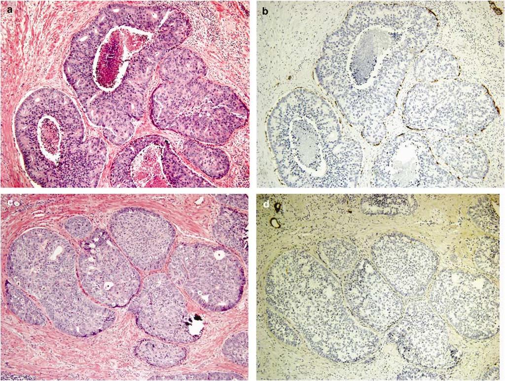 Figure 9 (a) In a radical prostatectomy following the diagnosis of IDC-P on prostate biopsy, a solid and dense cribriform pattern of IDC-P with prominent