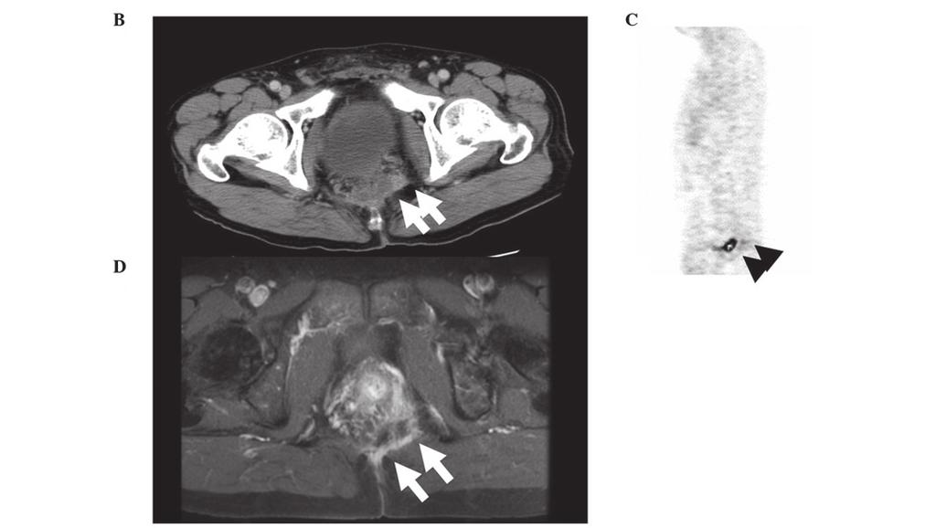 766 MOKUTANI et al: PARTICLE BEAM RADIOTHERAPY FOR LOCALLY RECURRENT RECTAL CANCER Figure 1. Summary of case 1. (A) Course of treatment following surgical resection.