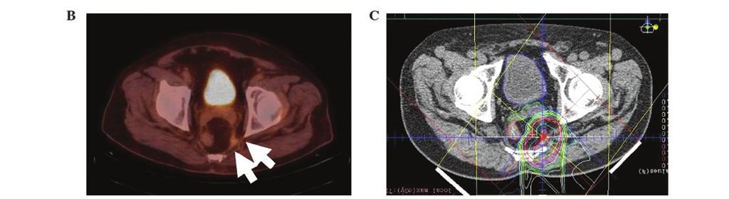 768 MOKUTANI et al: PARTICLE BEAM RADIOTHERAPY FOR LOCALLY RECURRENT RECTAL CANCER Figure 3. Summary of case 3. (A) Course of treatment following endoscopic mucosal resection.