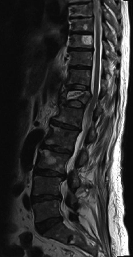 Bone Cement-Augmented Percutaneous Short Segment Fixation SJ Park, et al. A B C D E Fig. 5. Osteoporotic compression fracture with an intravertebral cleft at the T12 level in a 85-year-old female.