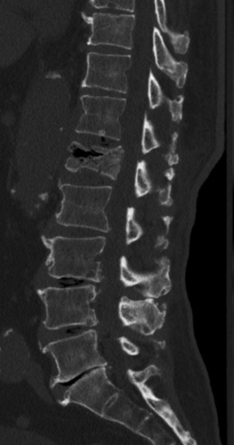 J Korean Neurosurg Soc 58 July 2015 A B C D E Fig. 6. Osteoporotic compression fracture with an intravertebral cleft (IVC) at the L1 level in a 83-year-old male.