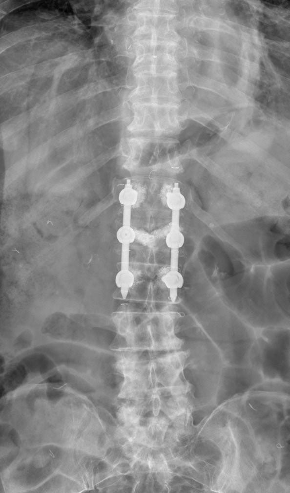 B and C : Simple radiographs after bone cement-augmented percutaneous short segment screw fixation show restored vertebral height and improved kyphotic deformity.