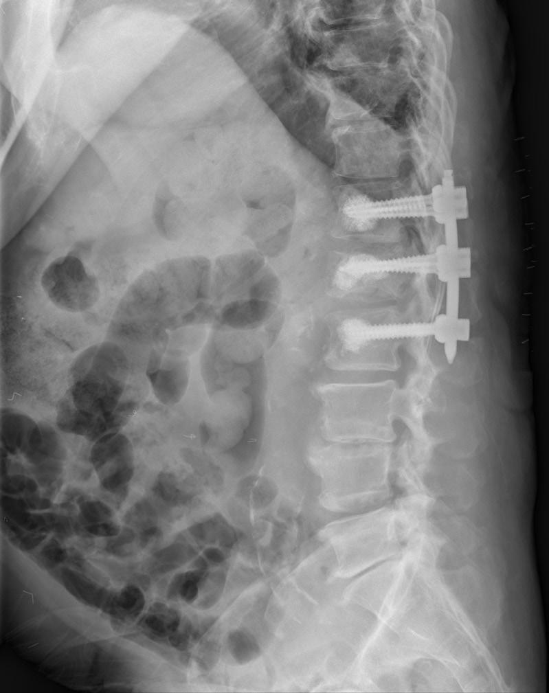 Patients with Kummell s disease are usually elderly and have severe osteoporotic spines; thus, multisegment fixation with bone fusion by a posterior approach