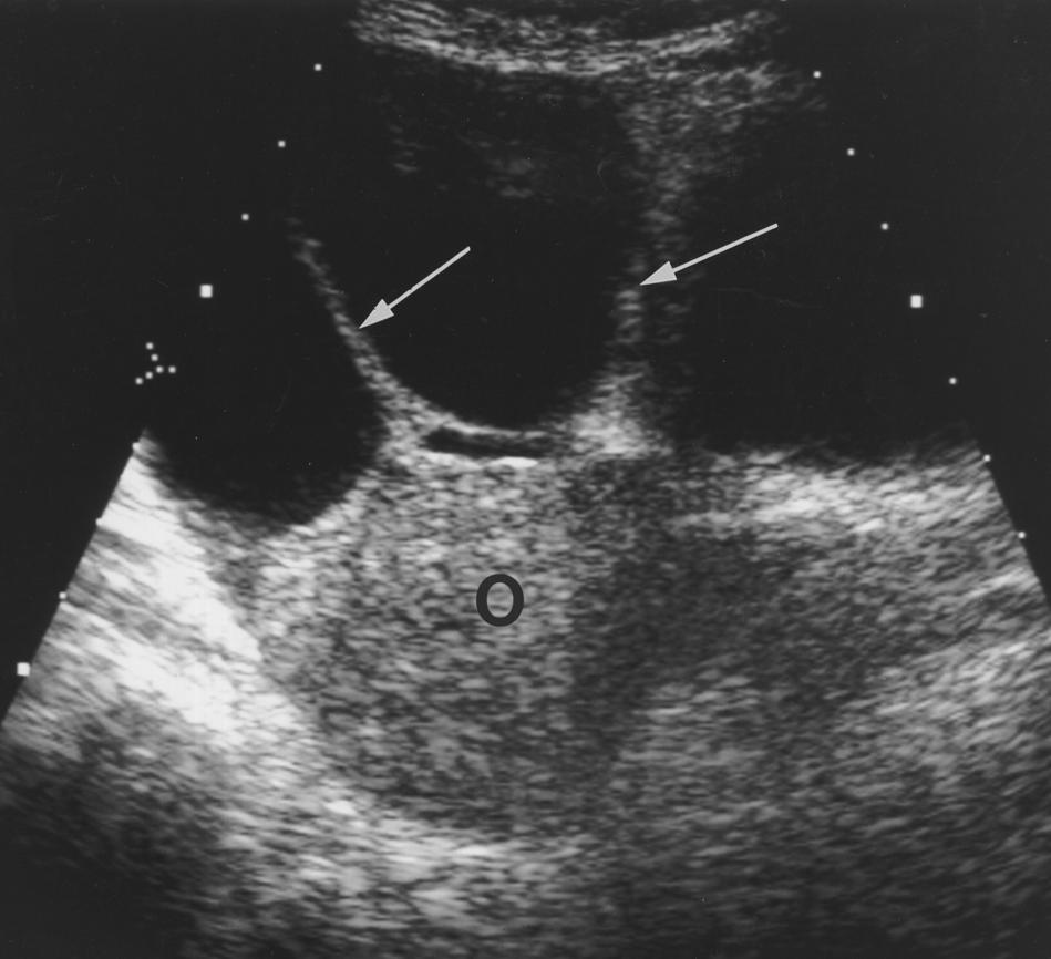 adnexal masses of the female pelvis. complex cystic adnexal mass generates a long list of differential diagnoses, including ovarian cancer.