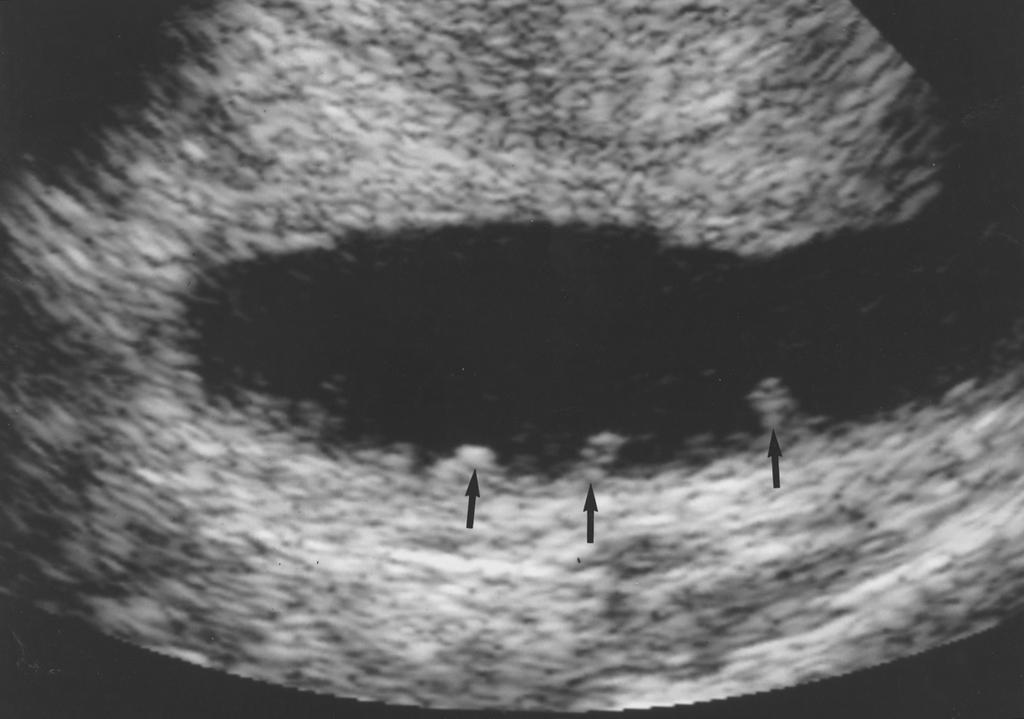 Jain Fig. 3. 35-year-old woman with Crohn s disease and peritoneal inclusion cyst.