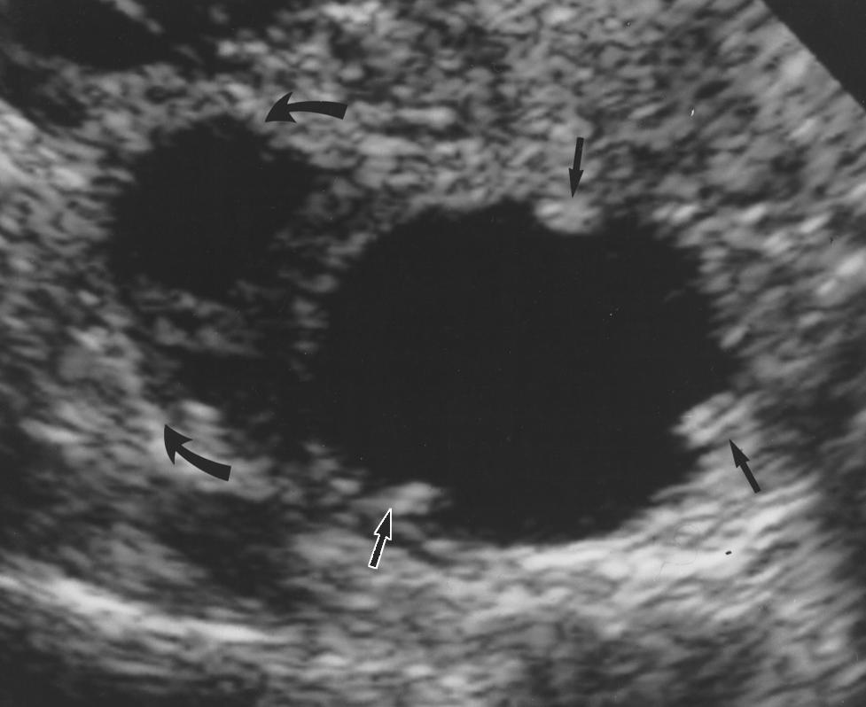 , Coronal endovaginal sonogram shows typical cogwheel appearance of peritoneal inclusion cyst similar to that of hydrosalpinx.