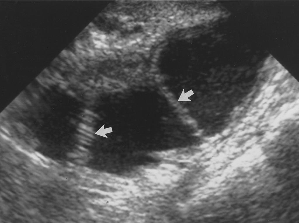 dhesions (arrow) extending in loculated fluid collection give appearance of a folded tube. Fig. 5.