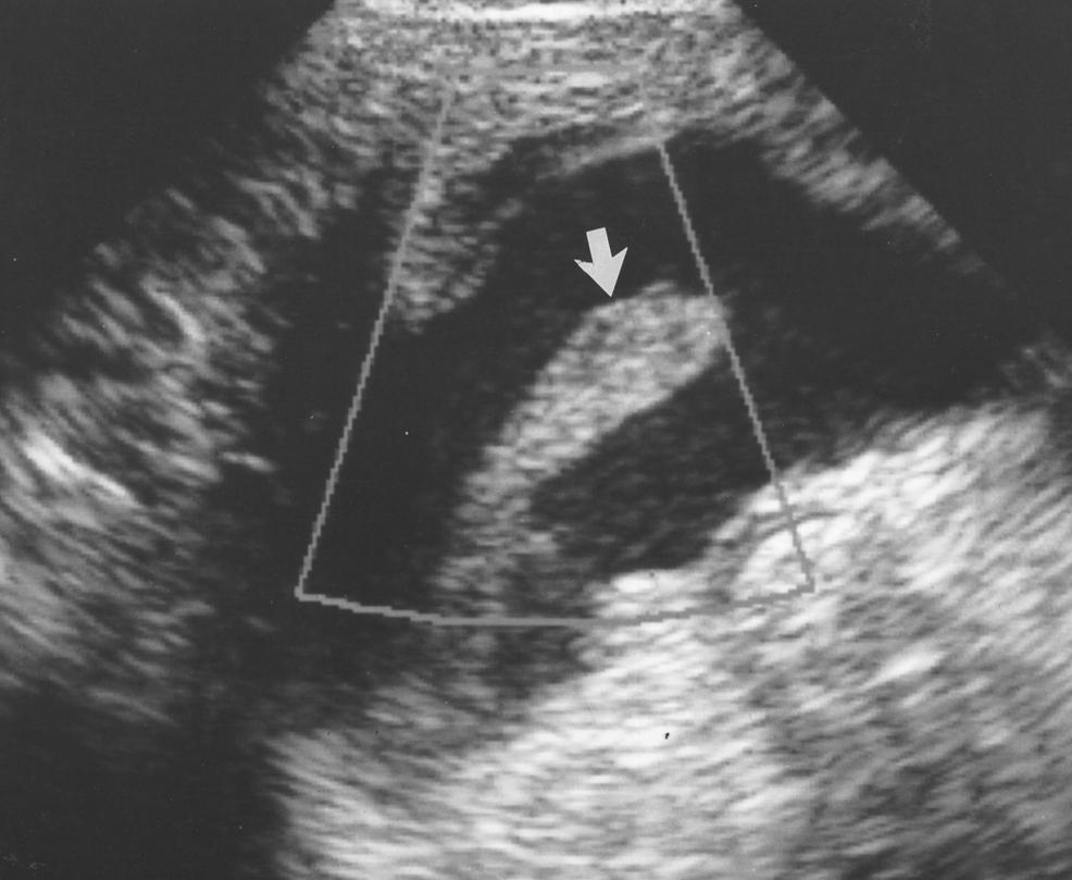 Sagittal endovaginal sonogram shows adhesions (arrows) that extend across entire width of fluid collection.