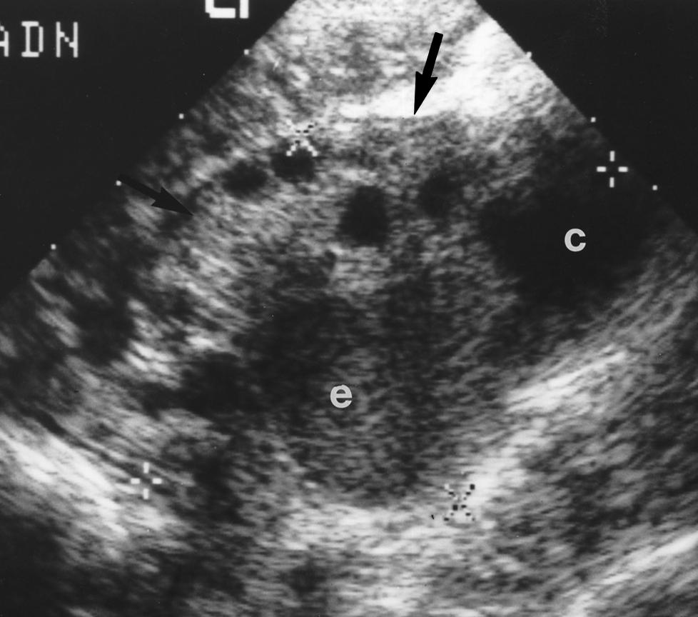 Jain Fig. 8. 27-year-old woman with endometriosis and peritoneal inclusion cyst. Coronal endovaginal sonogram reveals large multiloculated peritoneal inclusion cyst (arrows).