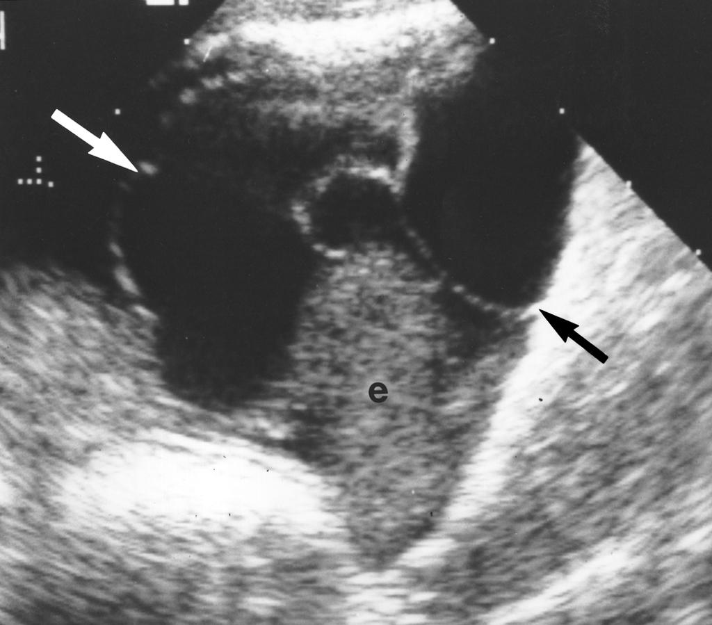 Endovaginal sagittal left adnexal sonogram shows some normal ovarian parenchyma with small follicles (arrow). Note small irregular anechoic locule of peritoneal inclusion cyst (c) adjacent to ovary.