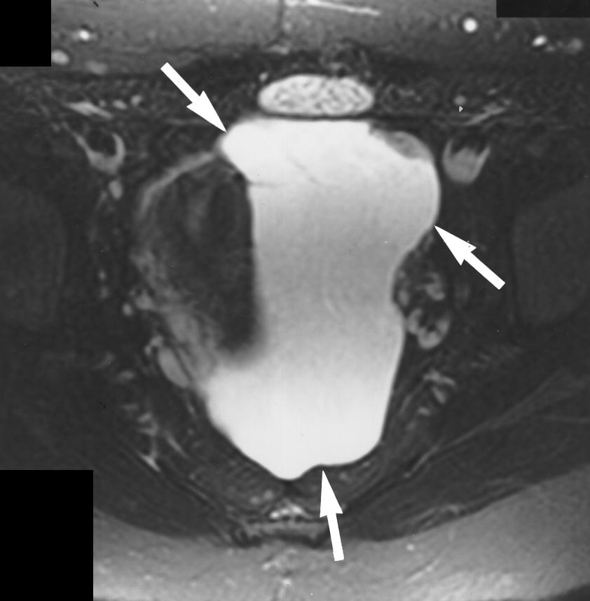 42-year-old woman with history (2 years earlier) of pelvic surgery, Crohn s disease, and peritoneal inclusion cyst.