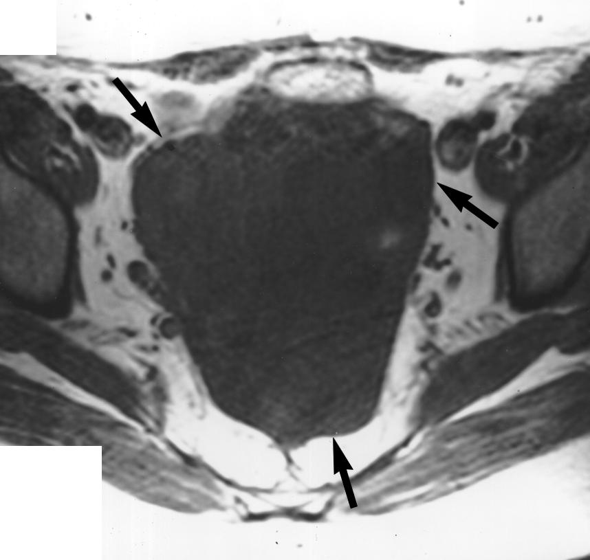 , xial fast spin-echo T2-weighted fat-saturated MR image (4000/102) shows homogeneous high-signalintensity fluid collection (arrows) inside pelvis. No septations or mural nodules were identified.