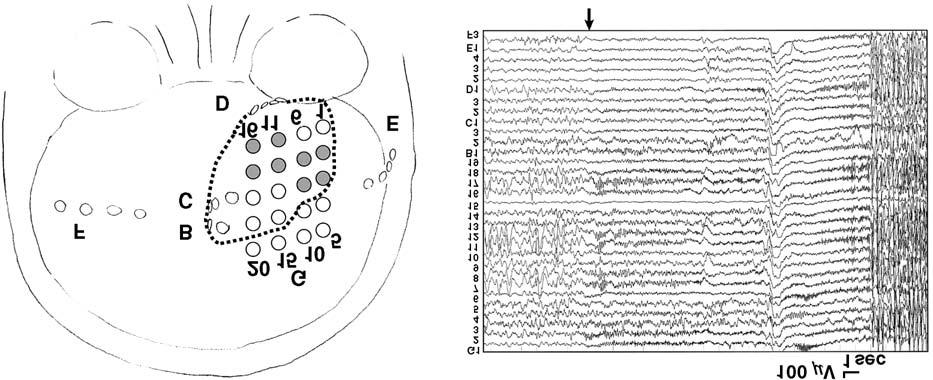 Visual Activation PET for Occipital Lobe Epilepsy 359 Fig. 4 left: Schematic illustration showing the seizure onsets and resected area.